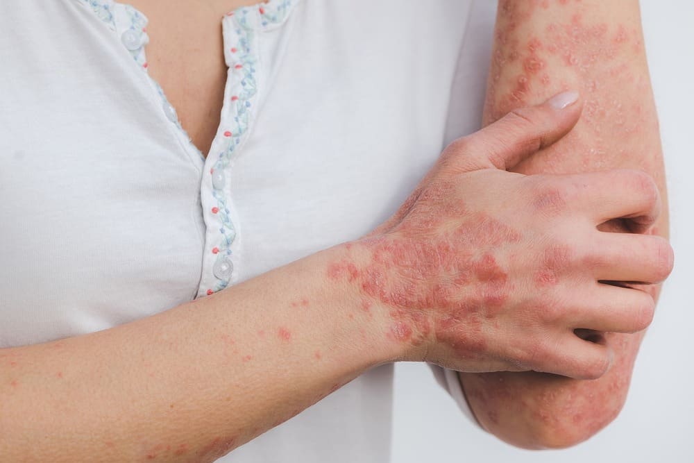 Probiotics for Psoriasis Treatment- Is There a Connection